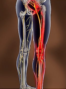 Holographic image of sciatic nerve in pain down right leg of person