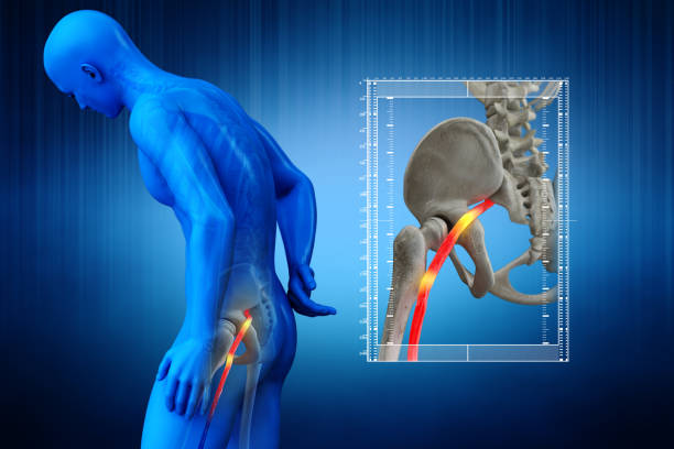 Holographic image of sciatica pain from the hip down the left leg. Lower back pain.