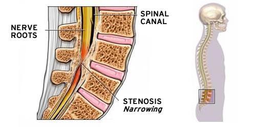 Picture of the anatomy of the lumbar spine, with bone changes creating narrowing of the space around the spinal cord.