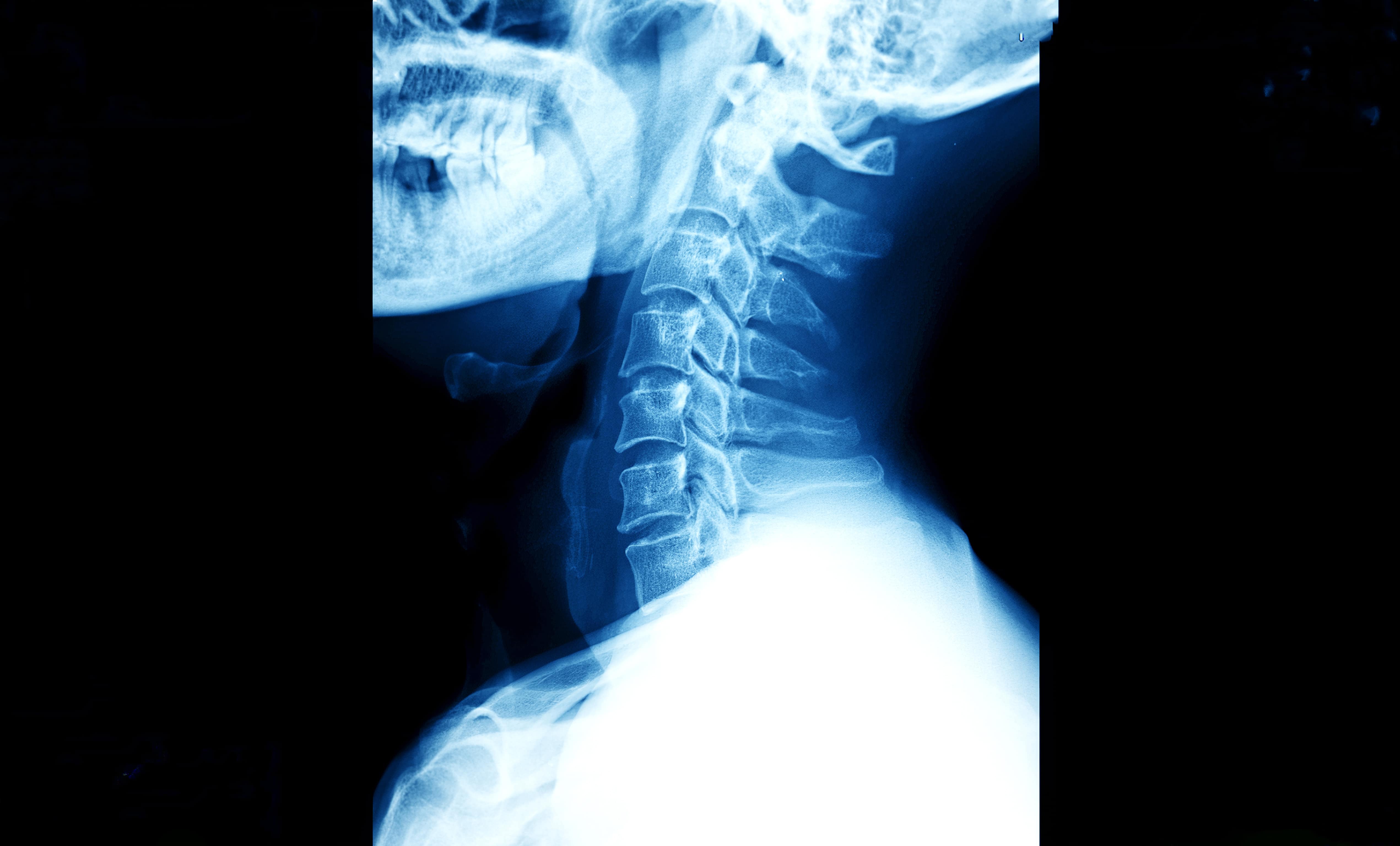 Plain x-ray of neck, to help diagnose neck disc bulge. Chiropractor and osteopaths use X-rays to help diagnose disorders.