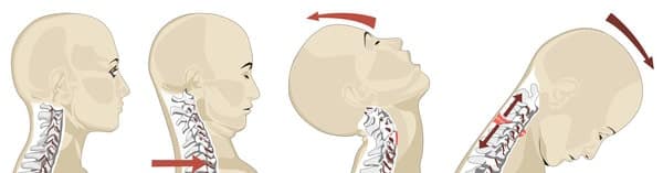 Whiplash injury of the neck showing in hyperextension and hyperflexion.