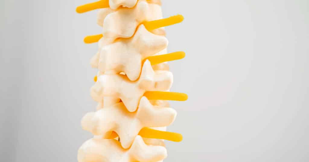 Lumbar spine, plastic model. Nerves are shown by yellow plastic. Osteoarthritis effects this part of spine.