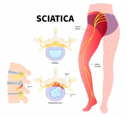 sciatica pain shown as a diagram down right leg to foot. Disc pathology is cause of sciatica pain. Pain shown in red with nerve displayed in yellow.