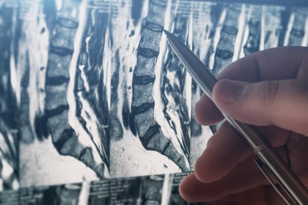 Lumbar spine MRI with lightbox behind films. Doctor is pointing with pen at area of concern. Patient for Drummoyne Chiropractic.