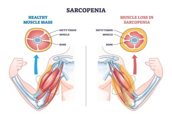 Sarcopenia, shown as a diagram. Muscle wasting shown on right of humerus region. Left full biceps and triceps shown to the elbow, wrist and hand.