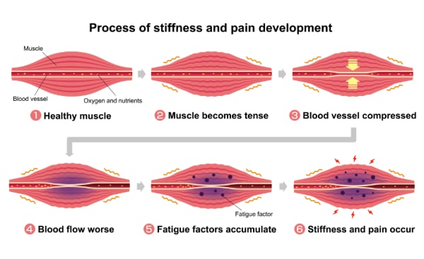 Process of muscle's stiffness and pain due to decrease in blood supply illustration