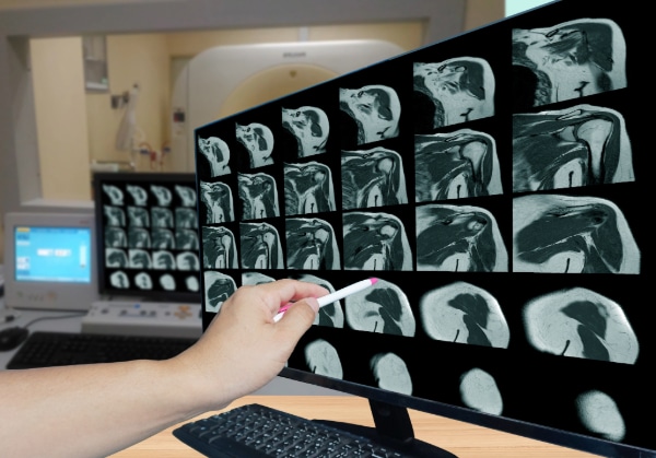 Image shows computer screen displaying MRI images of a shoulder joint. Dr is pointing out this issue on the screen with a pen. Rotator cuff muscles in display