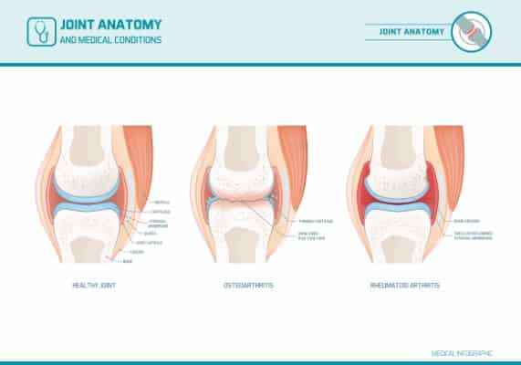 diagram of Joint anatomy, showing the difference between osteoarthritis and rheumatoid arthritis. Neck arthrits happens to facet joints