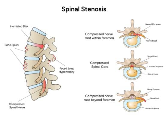 anatomical diagram showing Spinal stenosis nerve compression and bone spurs caused by arthritis of the cervical spine