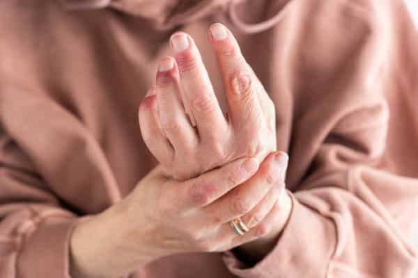 Close up of a women's hands suffering from arthritis showing redness swelling and enlarged joints