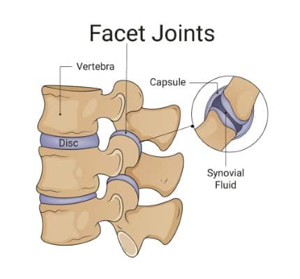 Diagram of the Facet Joints with labels on facet joint disc and vertebra. Close up on the facet joint showing articular surfaces and synovial fluid in-between.