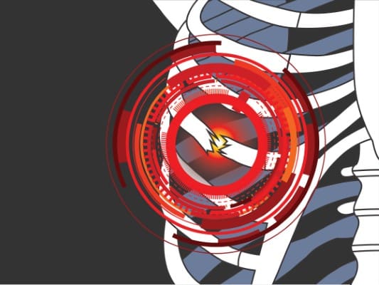 illustration of broken ribs causing rib cage pain. Pain shown in red radiating our from rib.