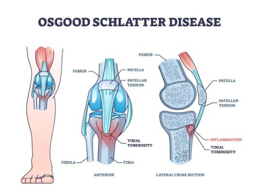 anatomical image of osggod schlatter disease with pain indicated in red.