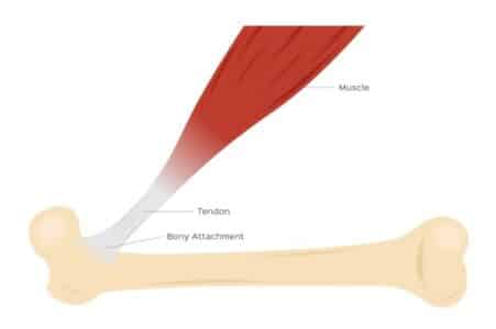 illustration showing how tendons attach muscle and bone together. Also shows site of tendonitis where tendon attaches to bone.