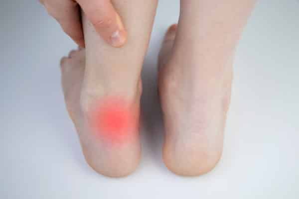 picture of young persons foot and ankle. looking from the back a red highlighted spot on back of her heel showing heel pain. Possibly from Sever's Disease.