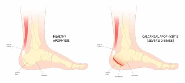 Anatomy picture of heel. Heel pain is indicated in red at back of heel.