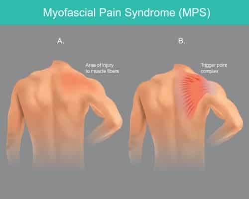 Myofascial pain syndrome shown in an infographic. Right shoulder has trigger points in red. Red shows area of pain.