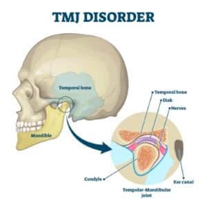 TMJ disorder vector illustration. Labeled jaw condition educational scheme. Diagram with joint clicking and pain anatomical structure and explanation. TMJD syndrome with mandibular movement closeup.