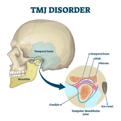 TMJ disorder vector illustration. Labeled jaw condition educational scheme. Diagram with joint clicking and pain anatomical structure and explanation. TMJD syndrome with mandibular movement closeup.