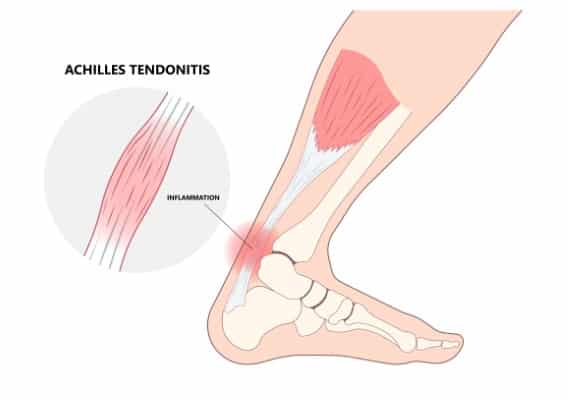 Anatomical diagram showing Inflammation of Achilles tendon injury