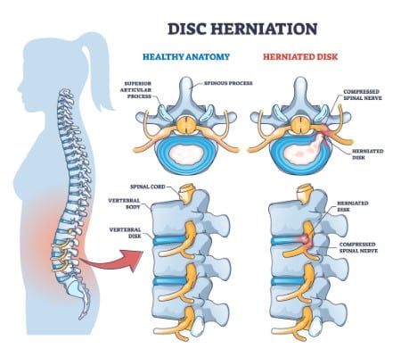 Disc herniation or spine nerve compression vs healthy anatomy outline diagram. Labeled educational scheme with superior articular process and herniated disk vector illustration. Vertebral body trauma.
