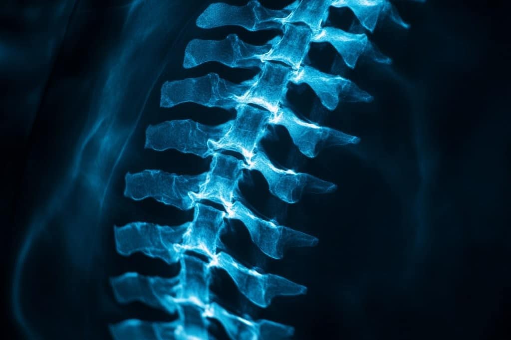 The x-ray film of the lumbo-sacral spine reveals signs of Spondylosis and Spondylolisthesis, including spinal collapse, reduced disc space, and bony spur formation
