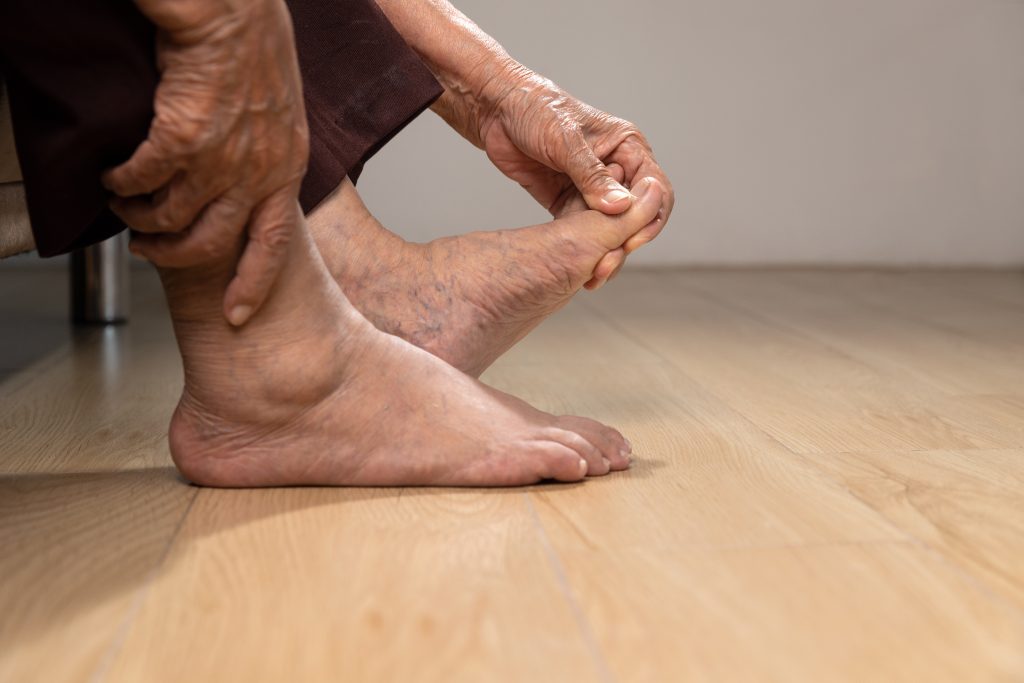 Flat foot shown as patient stretching left foot by pulling on toes